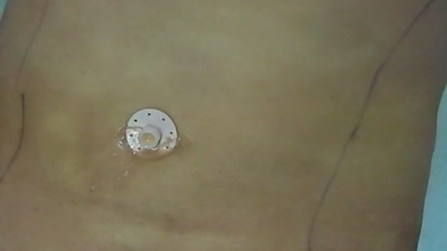根こそぎ竹田先生　おなかの脂肪吸引実況中継